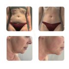 GlissContour 360 – Kompressziós, görgős testkezelő és arckezelő szalon gép