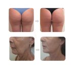 GlissContour 360 – Kompressziós, görgős testkezelő és arckezelő szalon gép