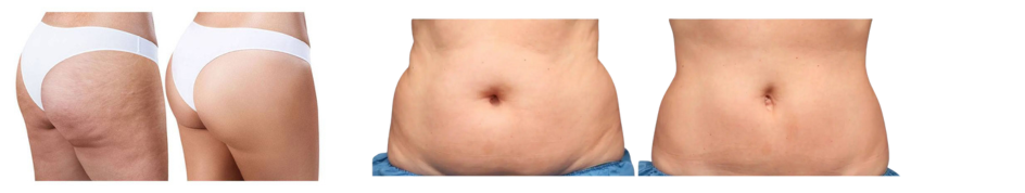 Mi az a kriolipolízis, és hogyan működik?