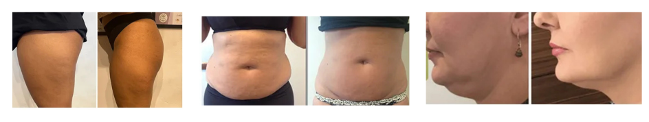 ThermoSculpt ID hatékonyan alkalmazható a test különböző területein