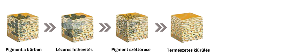 Hogyan működik a picosekundumos lézertechnológia?